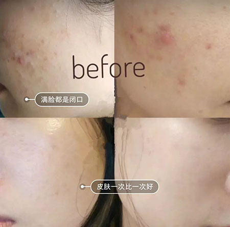 堪稱“換臉”的神奇煥膚術(shù)，你get了嗎？