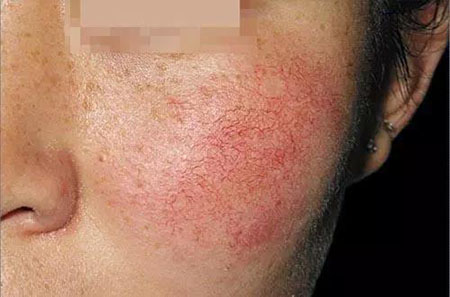 拒絕春季過敏、紅腫、發(fā)癢！敏感肌的救星來啦~