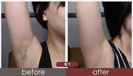 春季不脫毛，夏季獼猴桃！現(xiàn)在是脫毛的 佳時機(jī)~