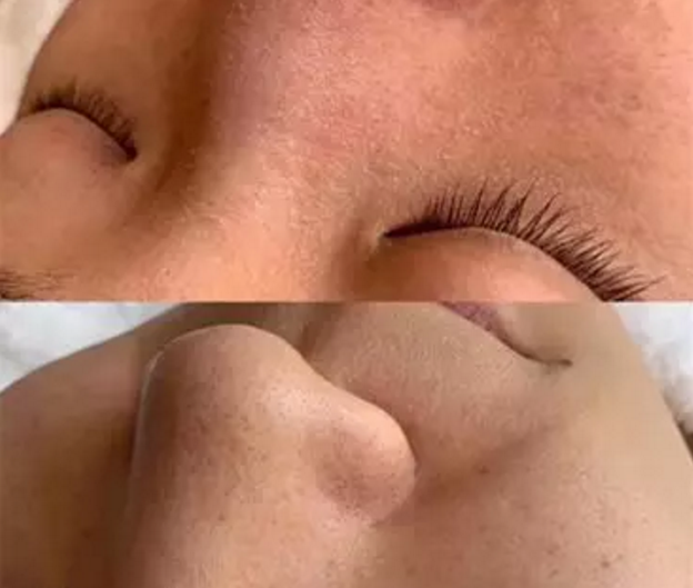 被粉刺、黑頭、毛孔、角質(zhì)糾纏？千萬(wàn)別忽視深層清潔！