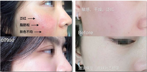 VN智能光電美膚：嚴(yán)重敏感肌會毀容?!從“爛臉”到正常只需這一步!