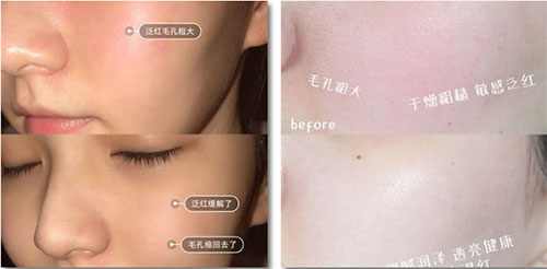 嚴(yán)重敏感肌會毀容?!從“爛臉”到正常只需這一步!