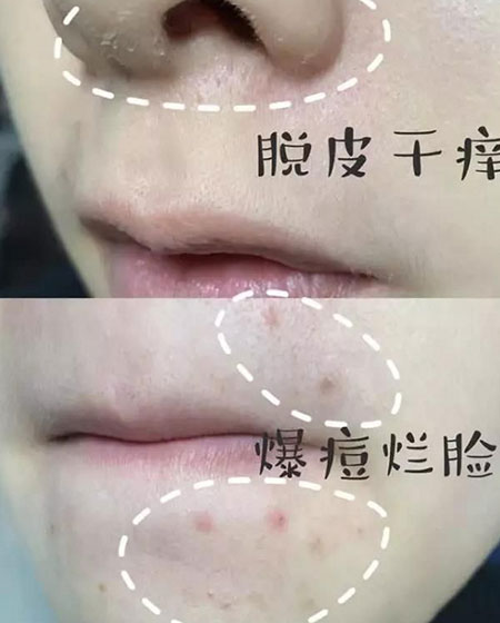 缺水是肌膚的萬惡之源你有這樣的皮膚情況嗎