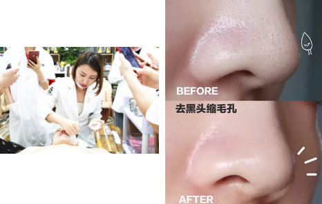 如何去黑頭？為什么要定期做去黑頭管理？VN給你好的答案